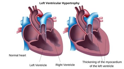 lv mildly dilated|mildly dilated left ventricle treatment.